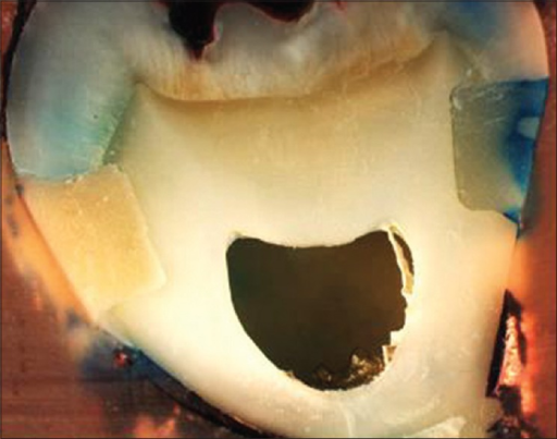 ionómero de vidrio en incrustación dental