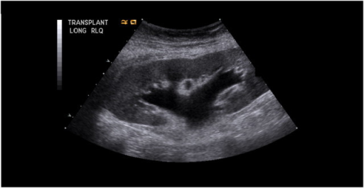 Renal transplant ultrasound. The renal ultrasound image | Open-i