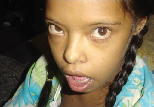 mental retardation facial characteristics Mental retardation facial characteristics