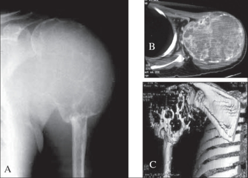 GCT of proximal humerus with extensive cortical expansi | Open-i