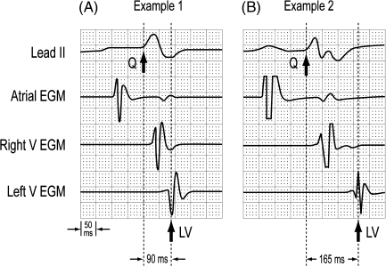 Two examples of QLV measurements. The calipers are alig | Open-i