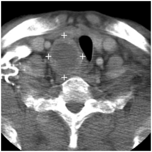 Parathyroid Carcinoma Ultrasound