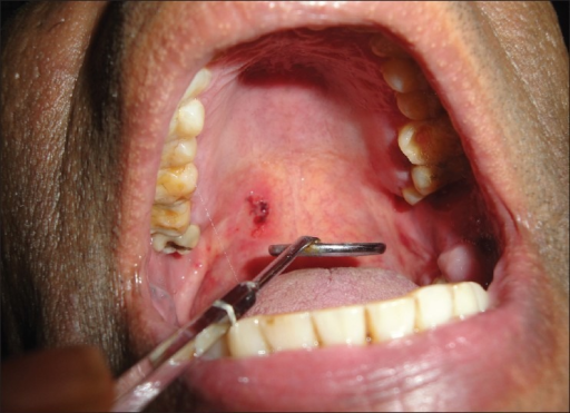 Blood blister on the soft palate in Case 1 Open i