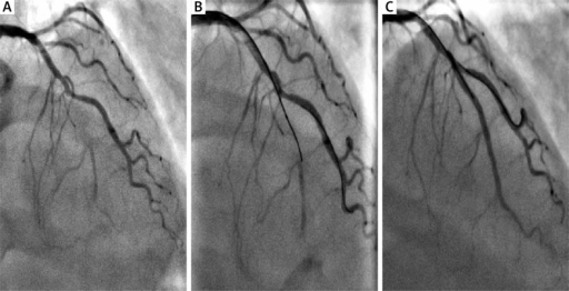 Coronary Angiography. A – Basal Coronary Angiography | Open-i