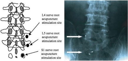 Schematic diagram and X-ray findings of nerve root acupuncture