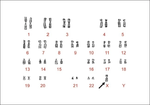 Karyotype of proband with Neurofibromatosis type 1, Tub | Open-i