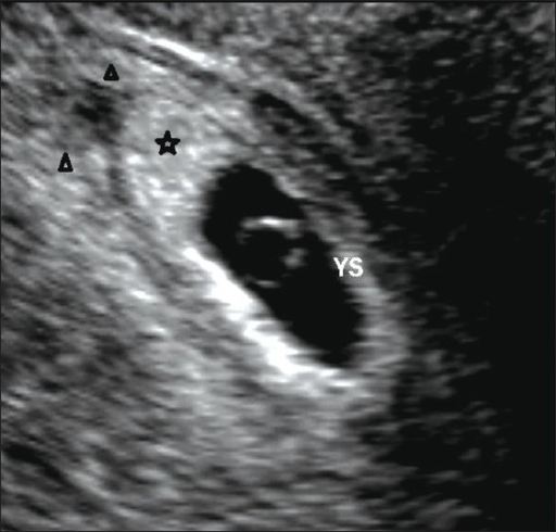 an-intrauterine-gestational-sac-with-a-double-ring-sign-open-i