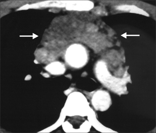 Castleman Disease Contrast Enhanced Chest Ct Scan Show Open I