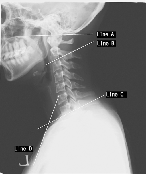 McGregor line was measured from the hard palate to the | Open-i