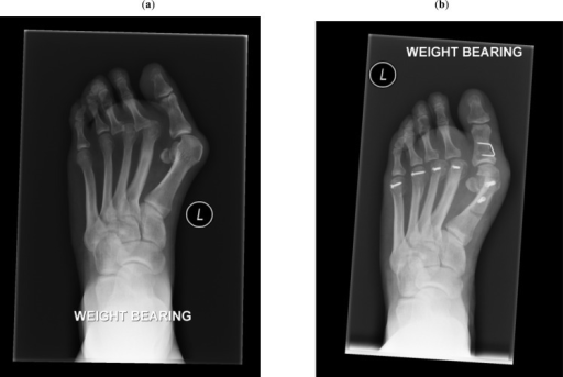 (a) Pre-operative forefoot with significant hallux valg | Open-i