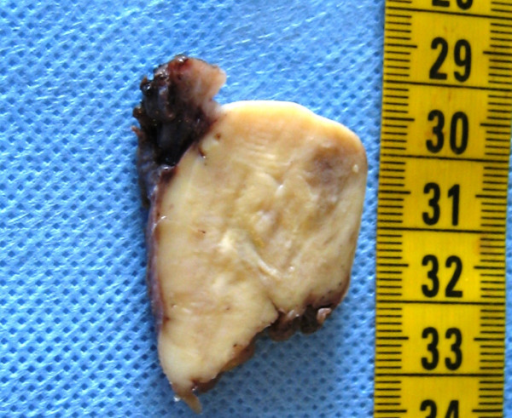 vaginal-melanoma-cross-section-of-surgical-sample-a-5-open-i