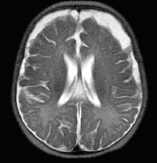 MRI HEAD (axial) without contrast. Meningitis related b | Open-i