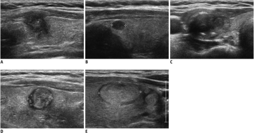 five-categories-for-us-diagnosis-of-solid-thyroid-nodul-open-i