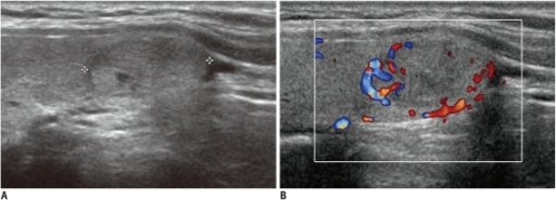 papillary-thyroid-carcinoma-designated-as-benign-from-t-open-i