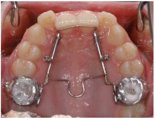 TPA proclination spring. Modified transpalatal arch (st | Open-i