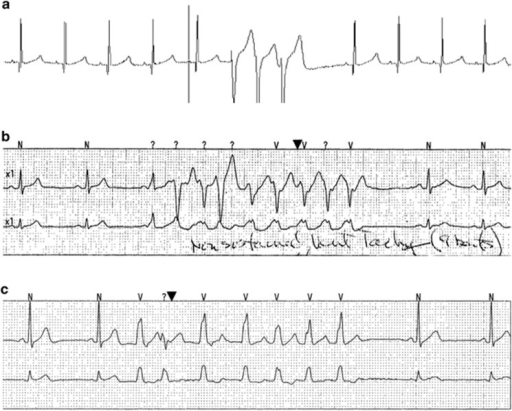 Nonsustained ventricular tachycardia (NSVT) in preclini | Open-i