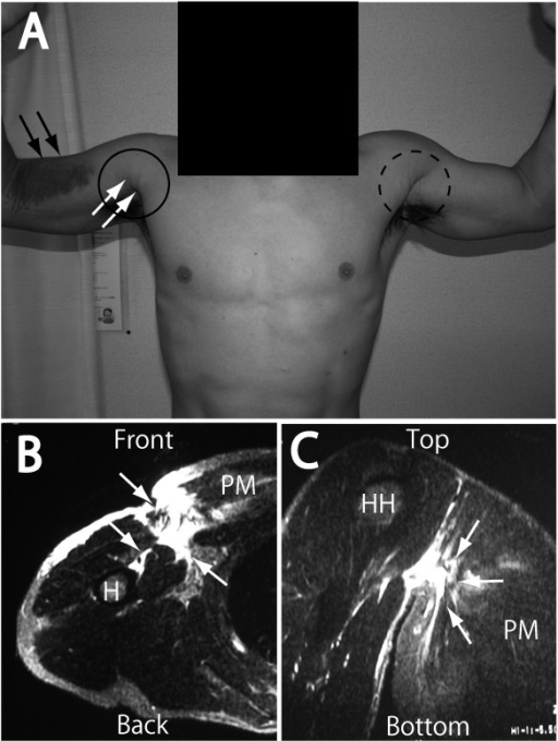 Pectoralis Major Tendon Tear 8358