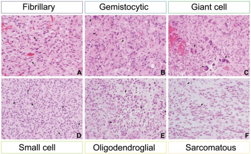 Distinct cell morphological types in clinical glioblast | Open-i