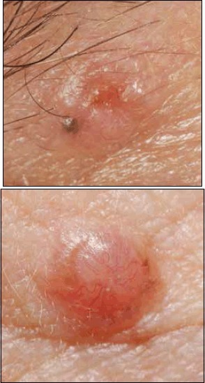 A B — Pigmented Basal Cell Carcinoma Pearly Te Open I