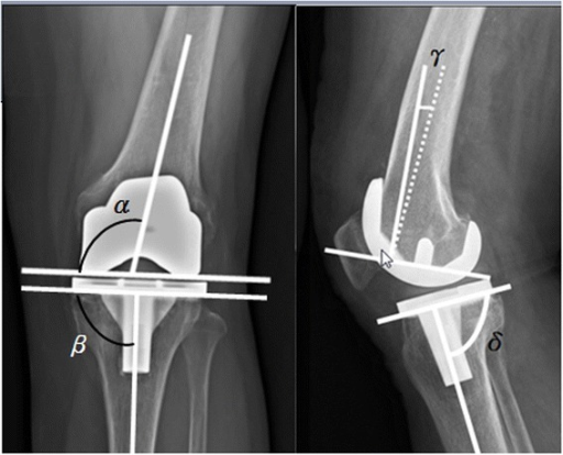 Radiograph showing the measurement of four component al | Open-i