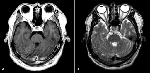 Magnetic Resonance Imaging The Eyeball Size And Scleral Thickness Are Normal In Both Eyes Magnetic Resonance Imaging The Eyeball Size And Scleral Thickness Are Normal In Both Eyes