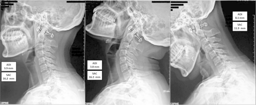 Neutral (left), extension (center), and flexion (right) | Open-i