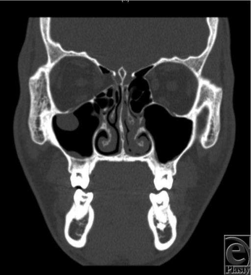 Coronal View Of Computed Tomography Max Face Revealing Open I