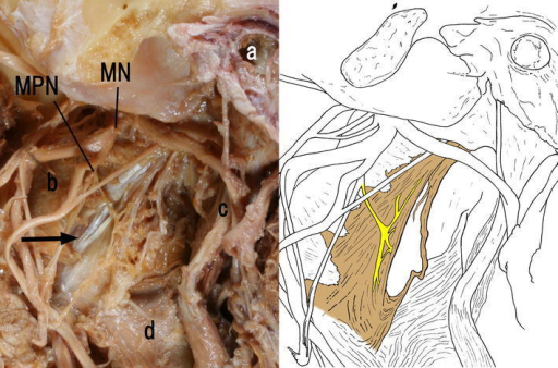 Type B. Left side appearance of the infratemporal fossa | Open-i