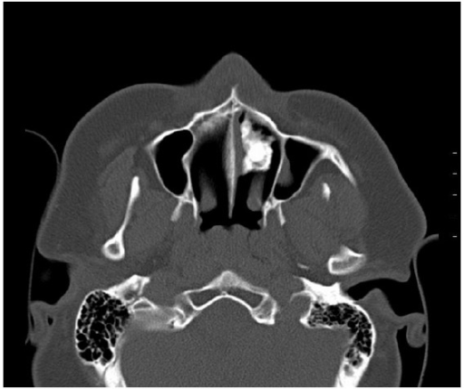 CT showing rhinolith. | Open-i